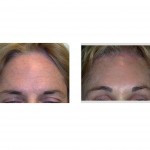 hairline-pretrichial-browlift-dr-barry-eppley-indianapolis