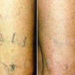 sclerotherapy-indianapolis-dr-barry-eppley1