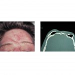 frontal-contour-defect-dr-barry-eppley1