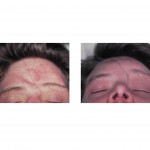 frontal-cranioplasty-dr-barry-eppley-indianapolis