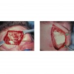 hydroxyapatite-cranioplasty-reconstruction-dr-barry-eppley-indianapolis