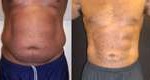 smart-lipo-male-abdomen-dr-barry-eppley-indianapolis