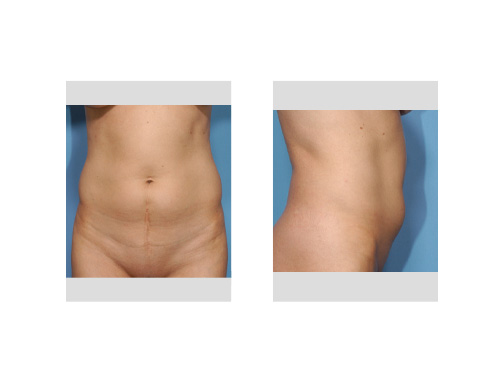 tummy tuck scars. the same vertical scar but