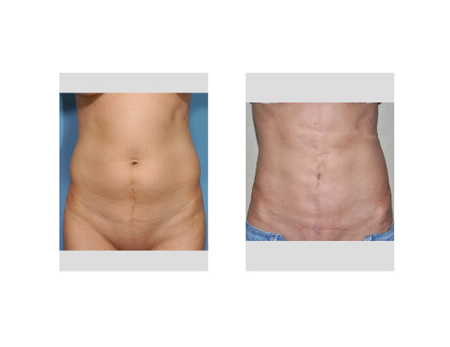 tummy tuck scars. vertical scar revised.
