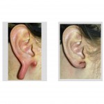 gauged-earlobe-flap-repair-dr-barry-eppley-indianapolis