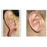 gauged-earlobe-reconstruction-dr-barry-eppley-indianapolis