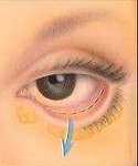 transconjunctival-lower-blepharoplasty-dr-barry-eppley-indianapolis
