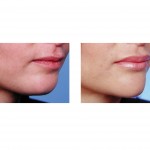 chin-advancement-aith-narrowing-dr-barry-eppley-indianapolis