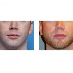 chin-and-jaw-angle-implants-dr-barry-eppley-indianapolis