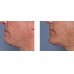 chin-implant-replacement-side-view-dr-barry-eppley-indianapolis