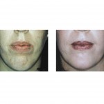 chin-shortening-and-narrowing-dr-barry-eppley-indianapolis