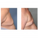 older-male-chest-liposuction-side-view-dr-barry-eppley-indianapolis