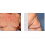 older-male-gynecomastia-dr-barry-eppley-indianapolis