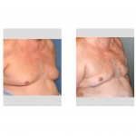 older-male-gynecomastia-liposuction-result-dr-barry-eppley-indianapolis