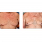 older-male-gynecomastia-lipouction-result-front-view-dr-barry-eppley-indianapolis1