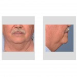 older-male-neck-fullness-wattle-dr-barry-eppley-indianapolis