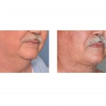 older-male-neck-liposuction-oblique-view-dr-barry-eppley-indianapolis