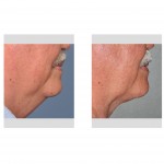 older-male-neck-liposuction-side-view-dr-barry-eppley-indianapolis