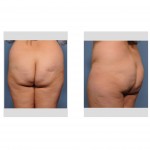 brazilian-butt-lift-before-surgery-dr-barry-eppley-indianapolis