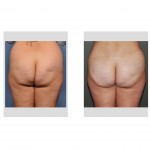 brazilian-butt-lift-results-back-view-dr-barry-eppley-indianapolis