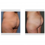 brazilian-butt-lift-results-left-oblique-view-dr-barry-eppley-indianapolis