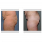 brazilian-butt-lift-results-side-view-dr-barry-eppley-indianapolis