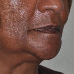 edentulous-witchs-chin-oblique-view