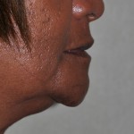 edentulous-witchs-chin-side-view1