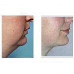 neck-liposuctin-without-chin-implant-dr-barry-eppley-indianapolis