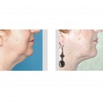 neck-liposuction-chin-implant-result-dr-barry-eppley-indianapolis
