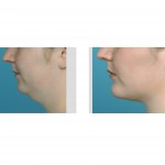 neck-liposuction-with-chin-implant-dr-barry-eppley-indianapolis