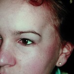 temporal-hollowing-dr-barry-eppley-indianapolis