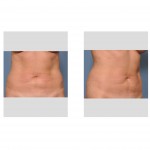 abdominal-liposculpture-before-dr-barry-eppley-indianapolis