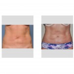abdominal-liposculpture-result-front-dr-barry-eppley-indianapolis