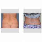 liposculpture-result-flanks-dr-barry-eppley-indianapolis