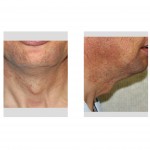 prominent-adams-apple-dr-barry-eppley-indianapolis