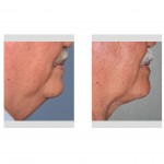 smartlipo-of-neck-older-patient-dr-barry-eppley-indianapolis