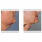 smartlipo-of-neck-younger-patient-dr-barry-eppley-indianapolis