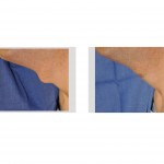 tracheal-reduction-intraoperative-view-dr-barry-eppley-indianapolis
