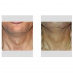 tracheal-reduction-result-front-view-dr-barry-eppley-indianapolis