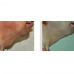 tracheal-reduction-result-side-view-dr-barry-eppley-indianapolis