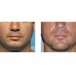 vertical-chin-lengthening-result-front-view-dr-barry-eppley-indianapolis