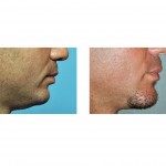 vertical-chin-lengthening-result-side-view-dr-barry-eppley-indianapolis