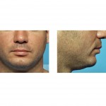 vertical-chin-shortness-dr-barry-eppley-indianapolis