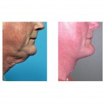 direct-neck-lift-for-men-dr-barry-eppley-indianapolis