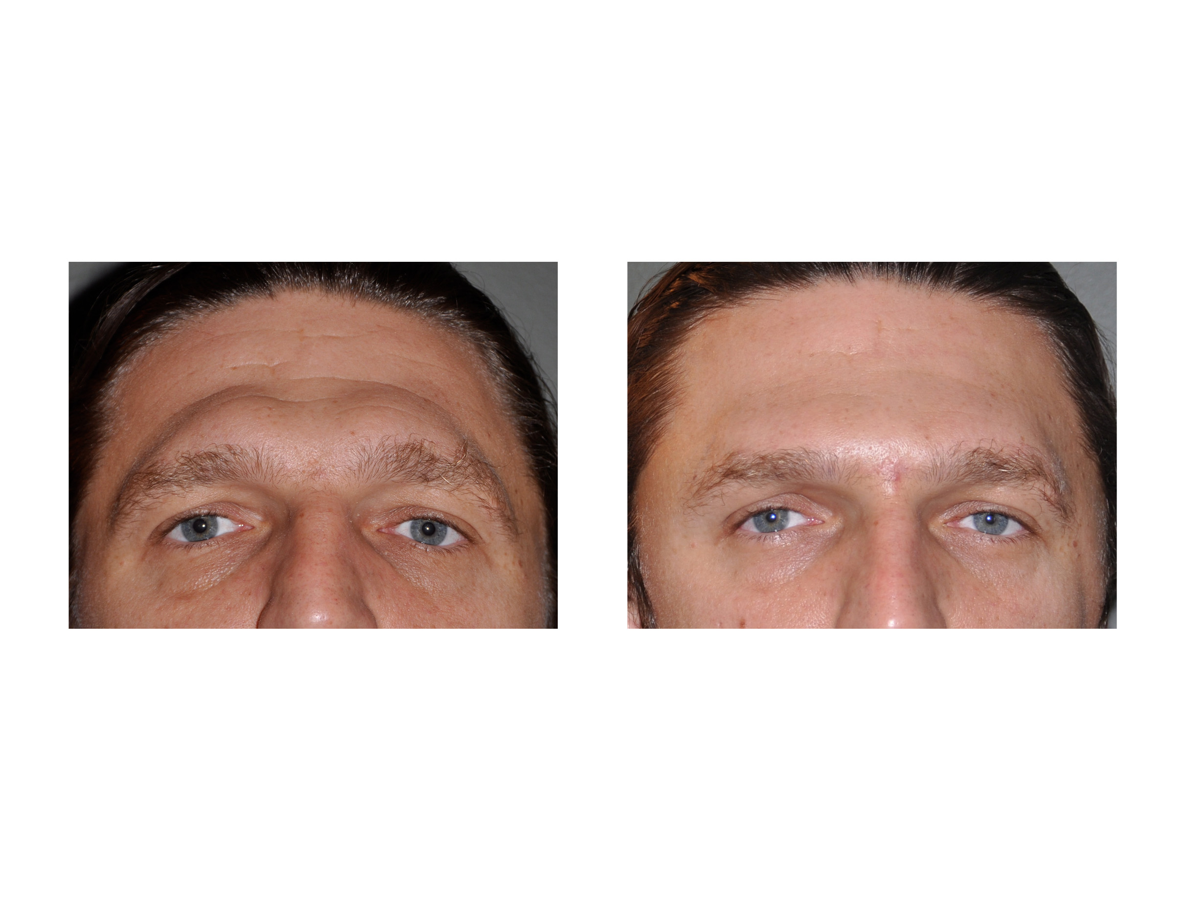 Reduce swelling brusing facial surgery