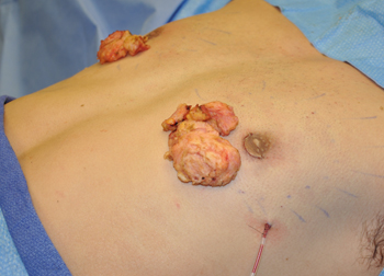 Treatment of steroid induced gynecomastia