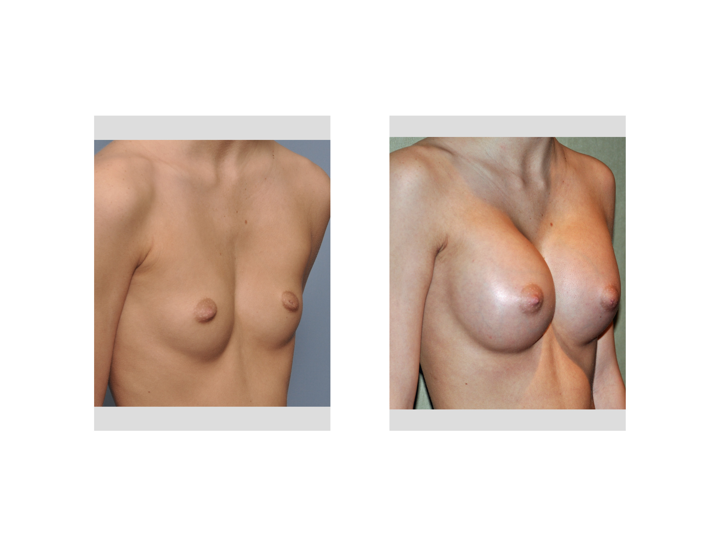 chest plastic surgery
