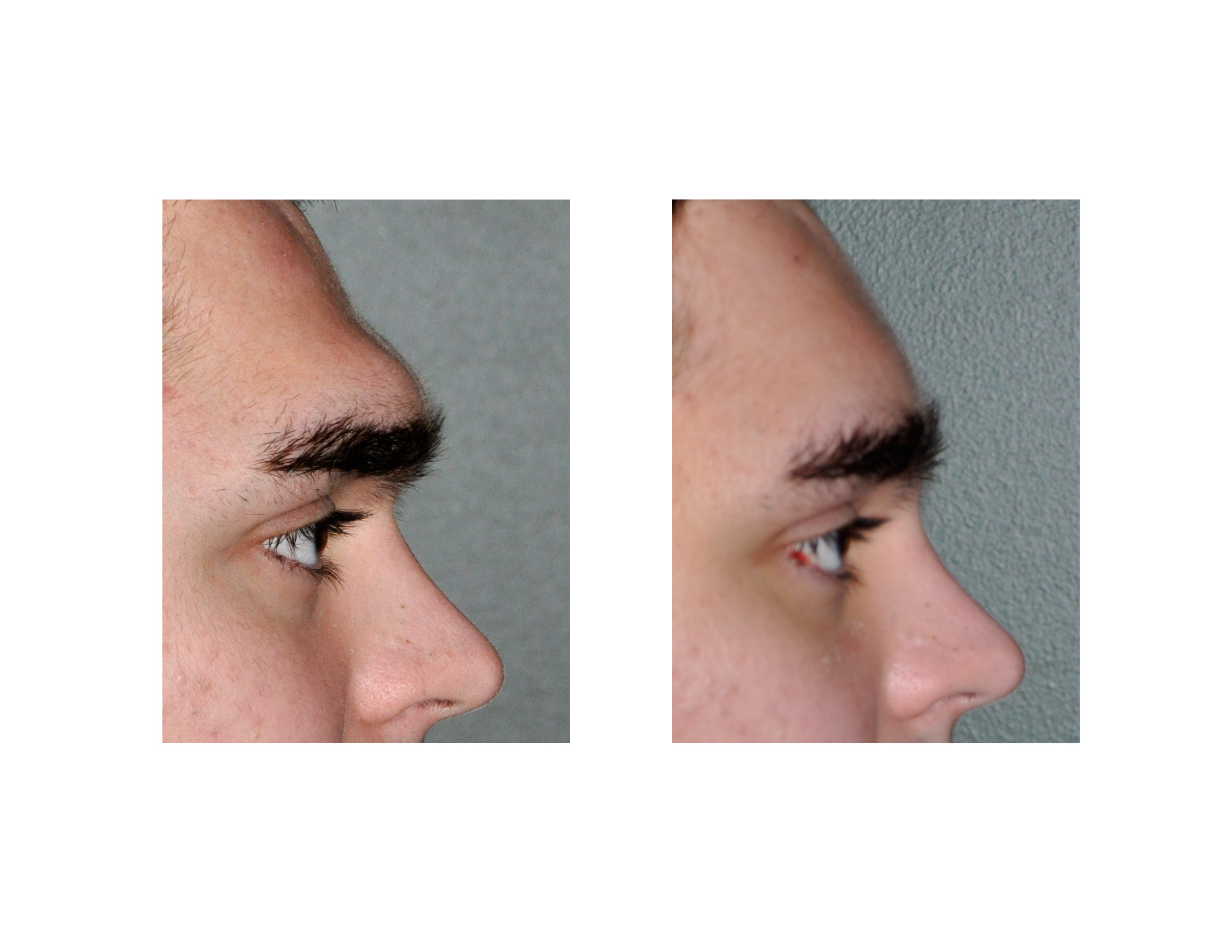 Large-Brow-Bone-Reduction-result-Dr-Barry-Eppley-Indianapolis