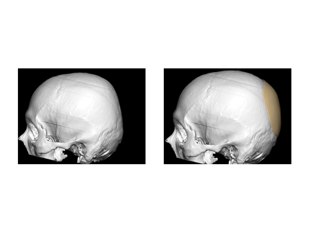 Blog Archivecase Study Custom Occipital Implant For Flat Back Of The